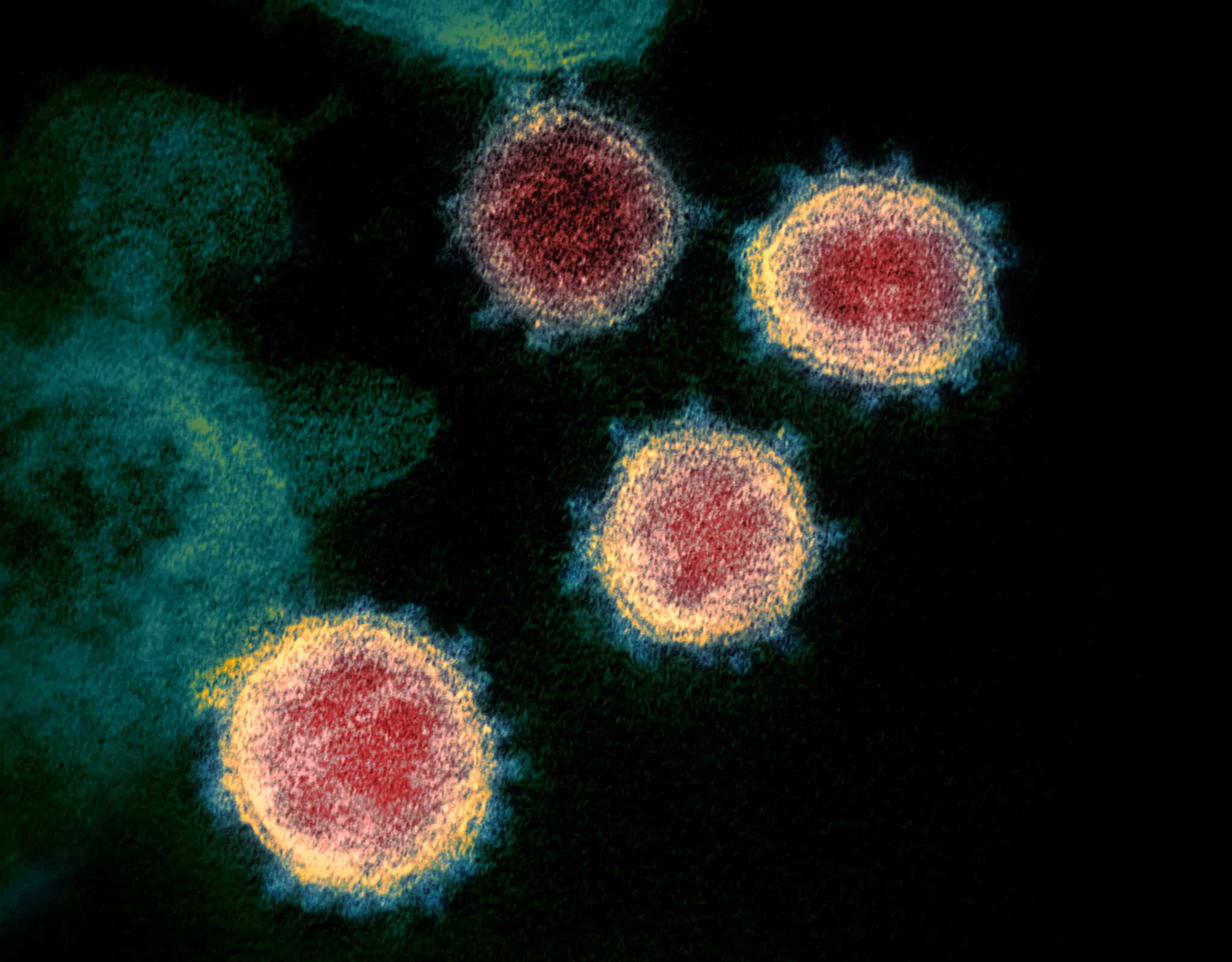MR Online | This colorized transmission electron microscope image shows SARS CoV 2also known as 2019 nCoV the virus that causes COVID 19 | MR Online