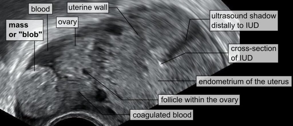 Ultrasound image of an ectopic pregnancy. [Photo: WikiJournal of Medicine.]